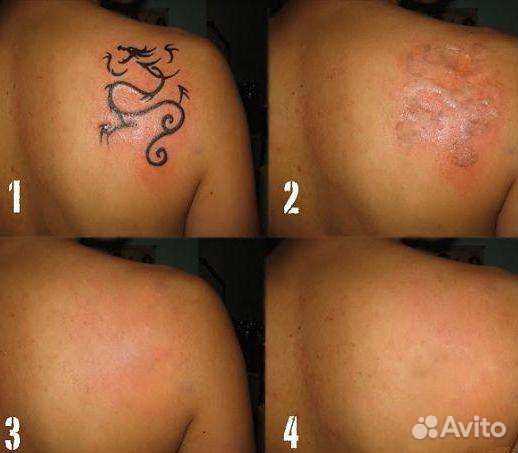 Удаление Татуировок Татуажа