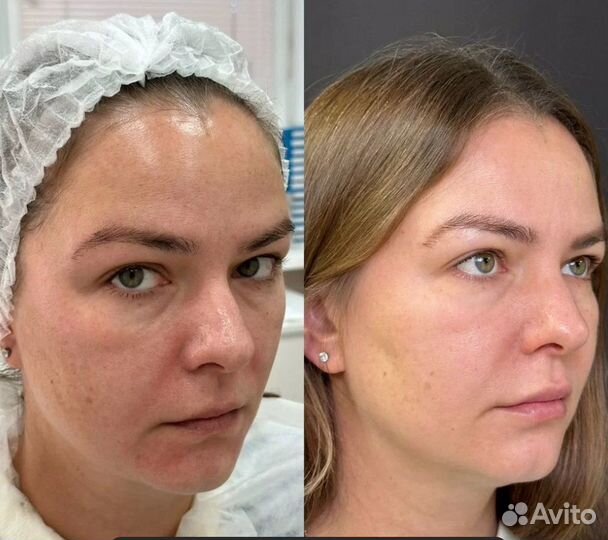 Супер омоложение и подтяжка лица без уколов