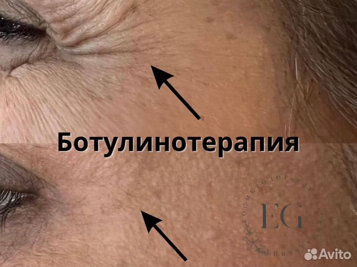 Контурная пластика. Ботокс. Диспорт. Full Face