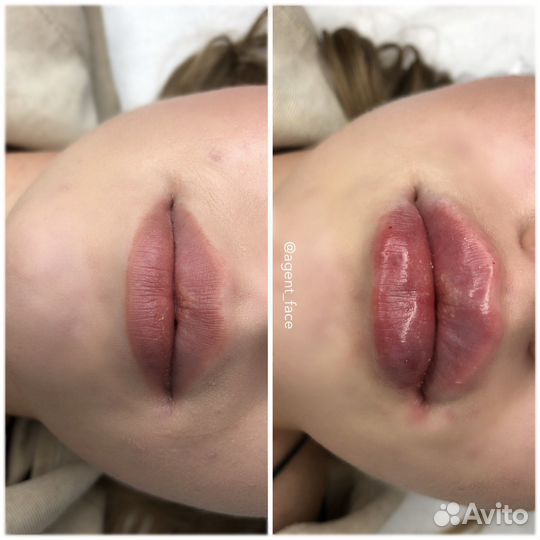 Увеличение губ
