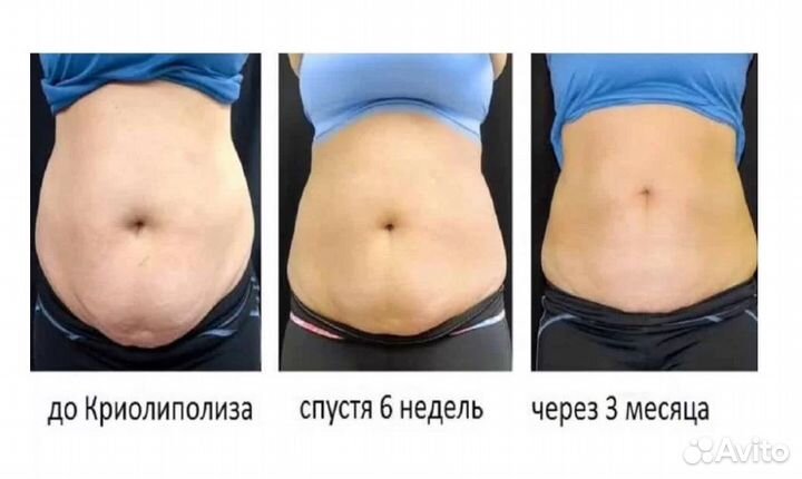 Липосакция без операции в Перми Мгновенное