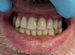 Починка зубного протеза