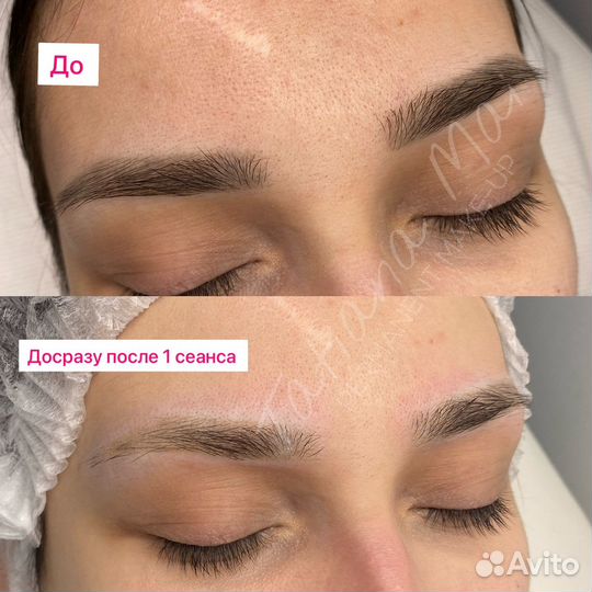 Удаление лазером татуажа и тату