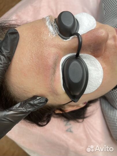 Удаление татуажа лазером