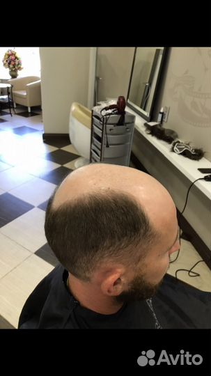 Мужская безоперационная система замещения волос