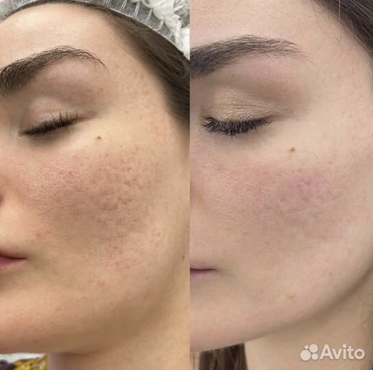 Фракционный РФ лифтинг микроигольчатый