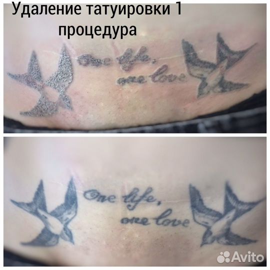 Удаление татуажа, перманентного макияжа, татуирово