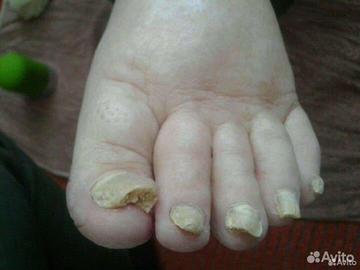 Лечебный педикюр проблемных ног