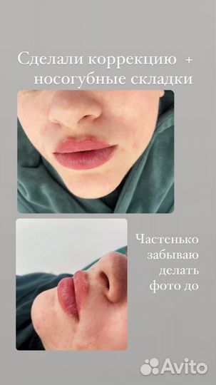 Увеличение губ