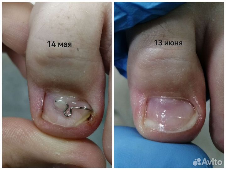 Снятие гель-лака с ногтей на ногах