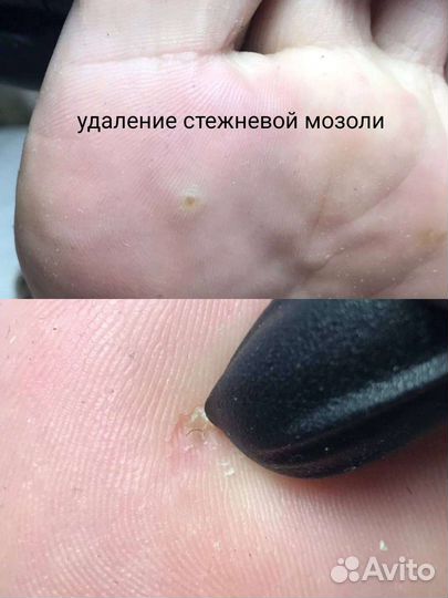 Педикюр любой сложности, титановая нить