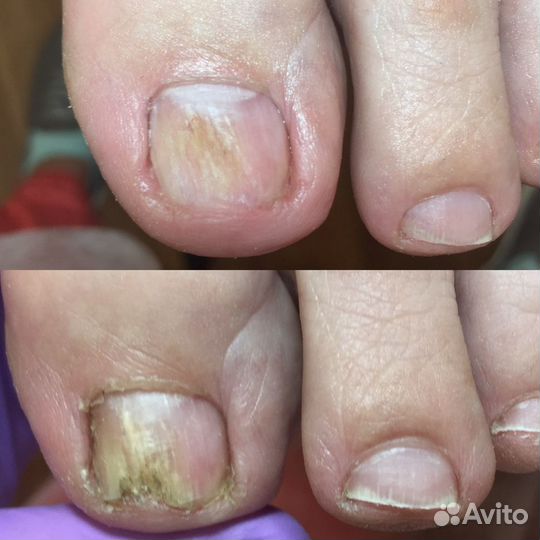 Педикюр аппаратный, основы подологии