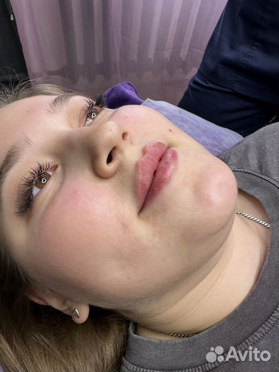 Косметлог увеличение губ