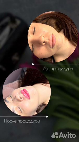 Увеличение губ / Выведение губ