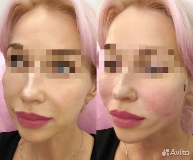 Косметолог нити губы ботокс лазер игольчатый РФ