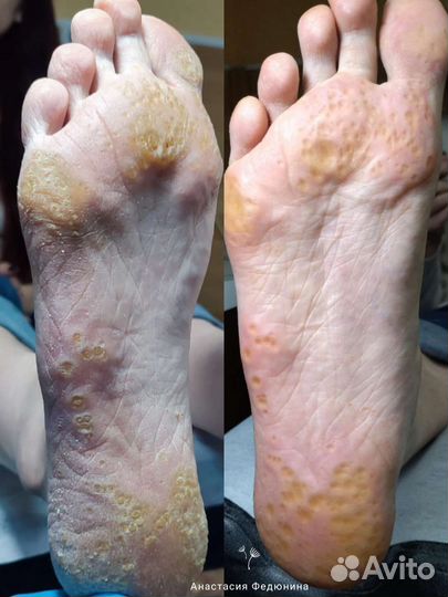 Подолог, Педикюр, SMART, Медицинский педикюр