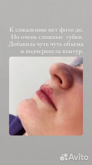 Увеличение губ