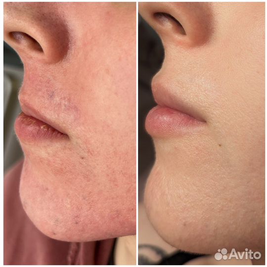 Лазерная шлифовка