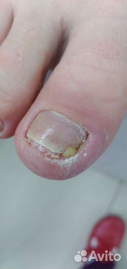 Медицинский педикюр подолог