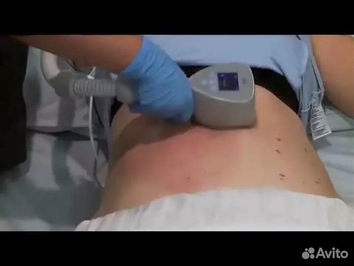 BTL exilis elite RF lifting