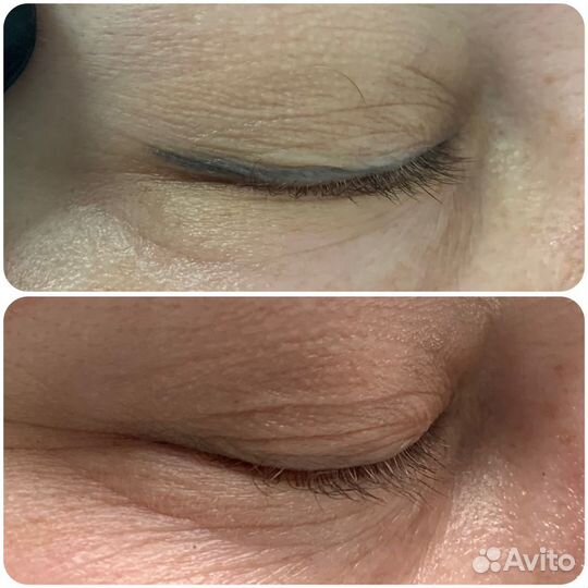 Лазерное удаление татуажа и татуировок