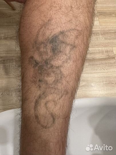 Лазерное удаление татуажа и татуировок