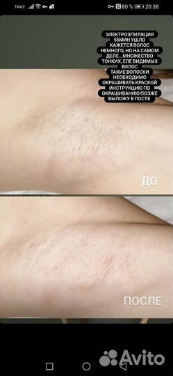 Электроэпиляция. Депиляция. ваксинг/шугаринг