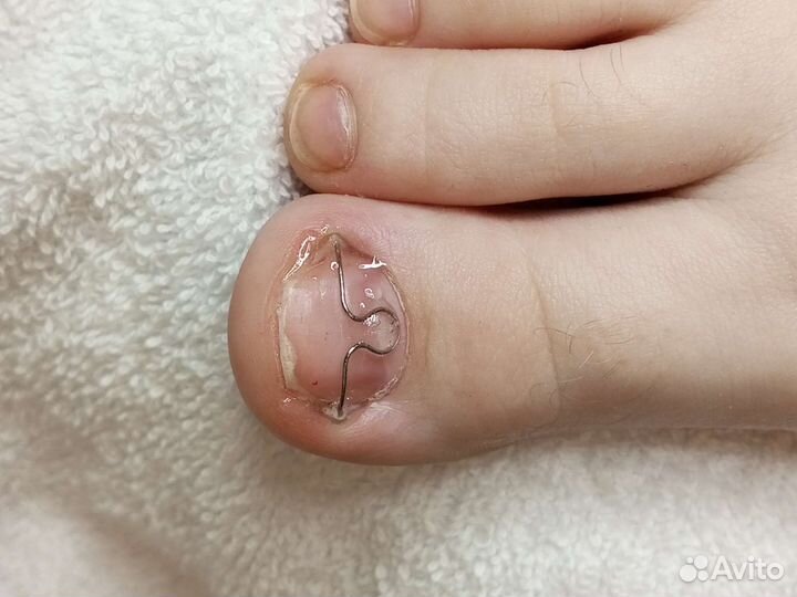 Обработка вросшего ногтя