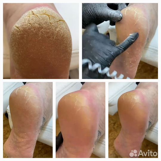 Педикюр проблемных стоп и ногтей (Подолог)