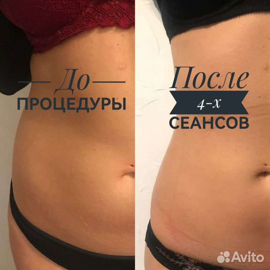 Коррекция тела и лица по технологии indiba индиба