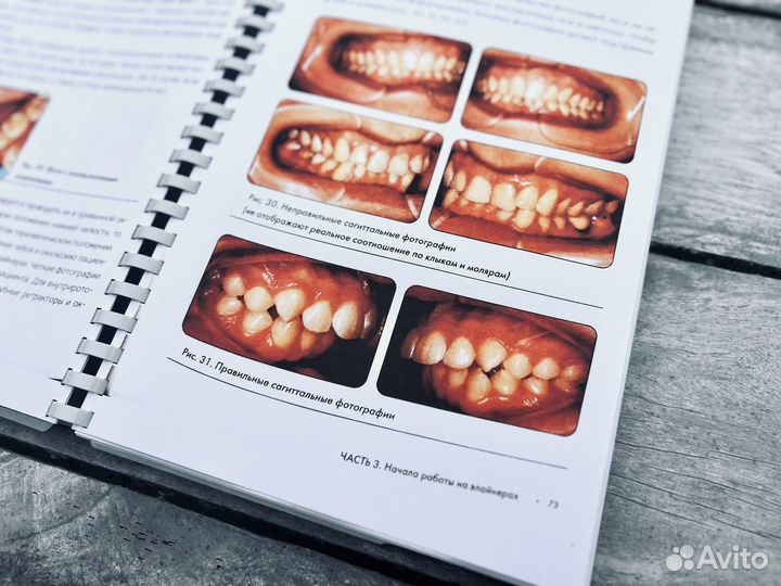 Прозрачная ортодонтия