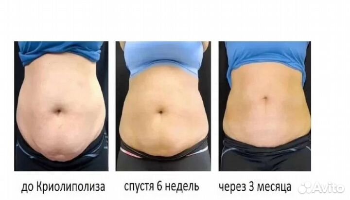 Модель на криолиполиз