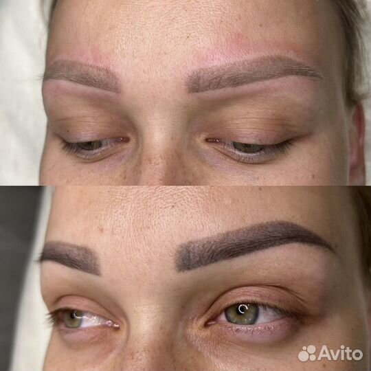 Удаление татуажа