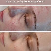 Косметолог чистка лица, Майкоп