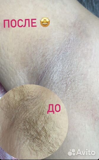 Депиляция воском