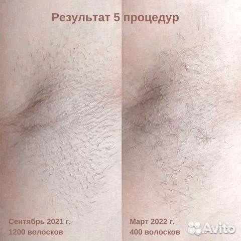 Электроэпиляция