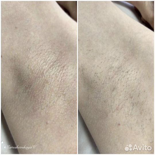 Электроэпиляция для мужчин и женщин