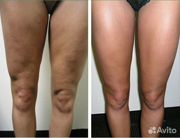 LPG массаж тела. Гуаша. Качественно. В центре