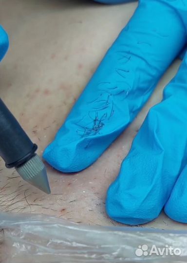 Электроэпиляция