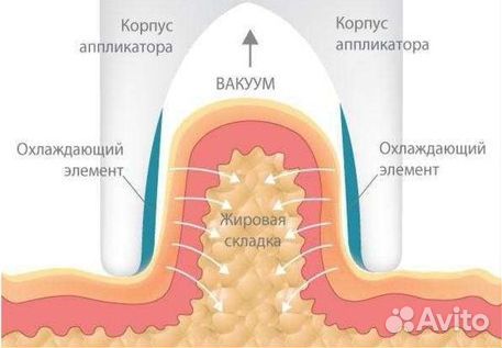 Антицеллюлитная жиросжигательная процедура (NEW)