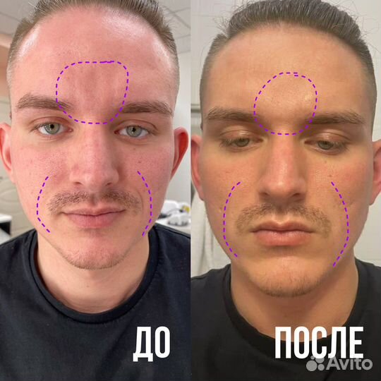 Тейпирование