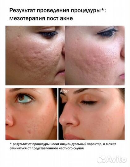 Дермапен ultima-E30-W, микронидлинг, мезотерапия