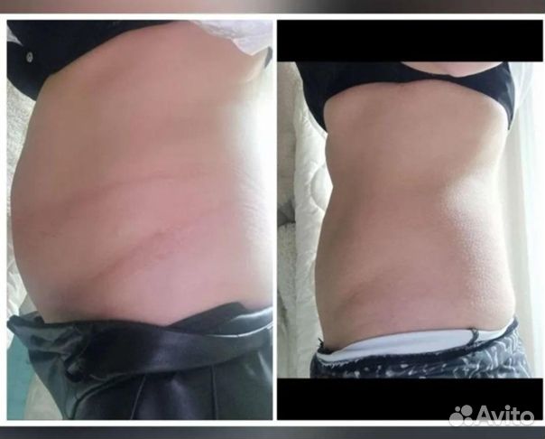 Аппаратное похудение и омоложение Индиба