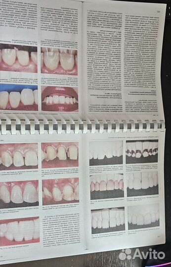 Керамические виниры Галип Гюрель