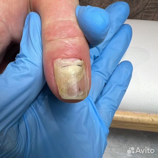 Лечебный педикюр