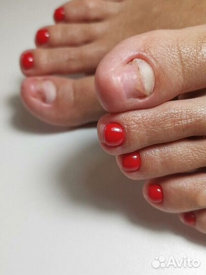 Вросший ноготь медицинский педикюр