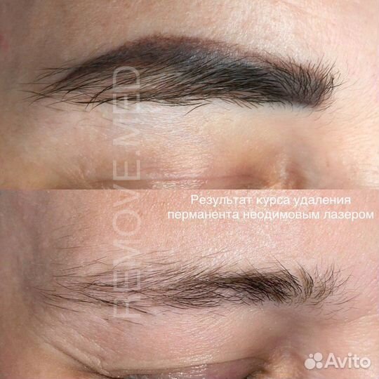 Удаление тату татуировок татужа, модель