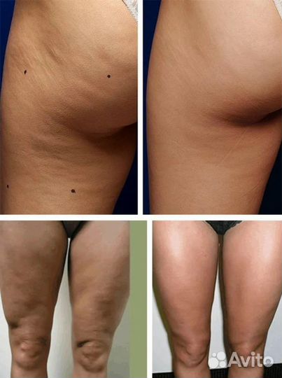 Коррекция фигуры -Арпаратный массаж