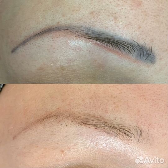 Удаление татуажа бровей модель