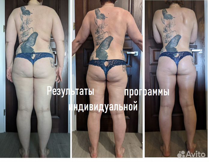 Коррекция фигуры (аппаратная:LPG,Turbo и много др)